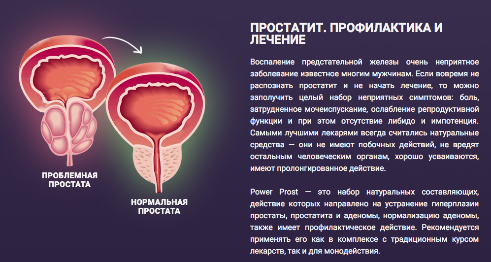 Воспалительные заболевания предстательной железы. Простата у мужчин симптомы. Простатита гиперплазии предстательной железы