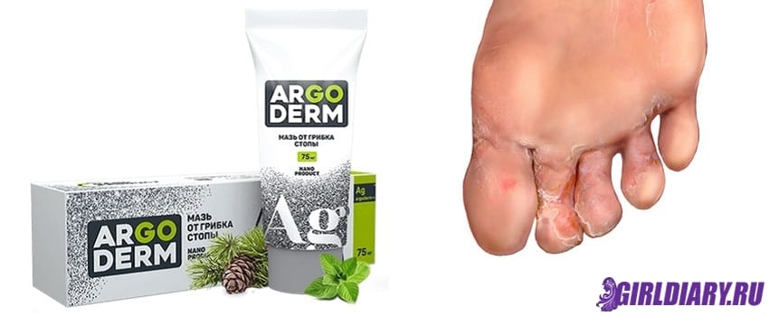 Распространенность грибкового поражения ног