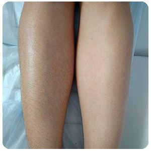 Женские ноги до и после применения фото спрея depilight для депиляции