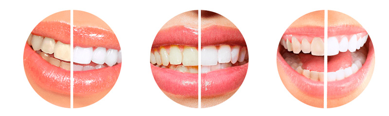 Результат До и После использования порошка для отбеливания зубов