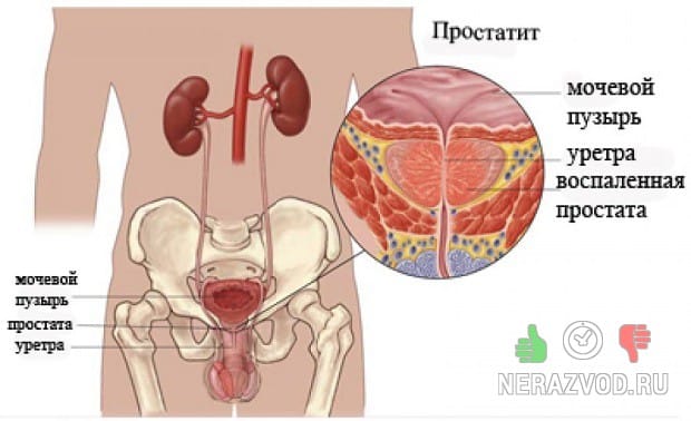 простатит