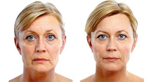 Женщина до и после применения miliskin от морщин