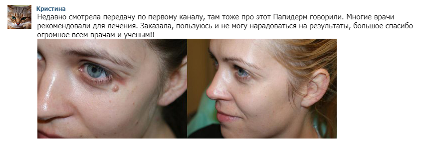 Dthherfwbk. Средство от бородавок и папиллом веррукацид. Средство для прижигания бородавок. Средство от выведения папиллом. Папиллом отзывы пациентов.