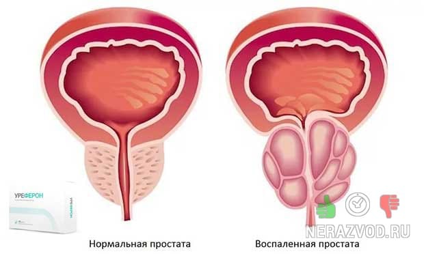 простатит