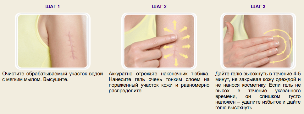 Применение геля Derma-Cote Дерма-Коте от шрамов и рубцов